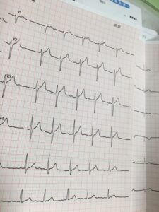 その動悸、大丈夫ですか？心房細動の初期症状・原因・治療を専門医が解説のアイキャッチ画像